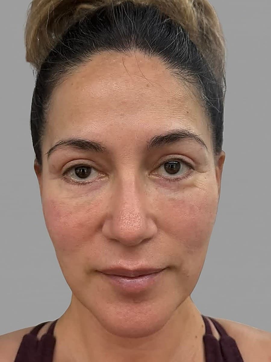 Susan K. before her brow session at Microblading LA